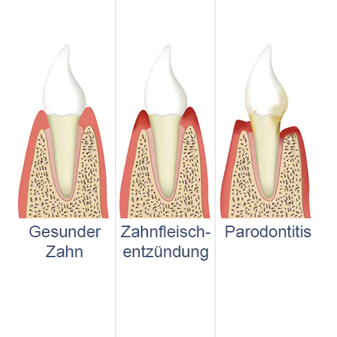 Zahnarztpraxis RHEIN WEISS Mainz Parodontitis Parodontologie